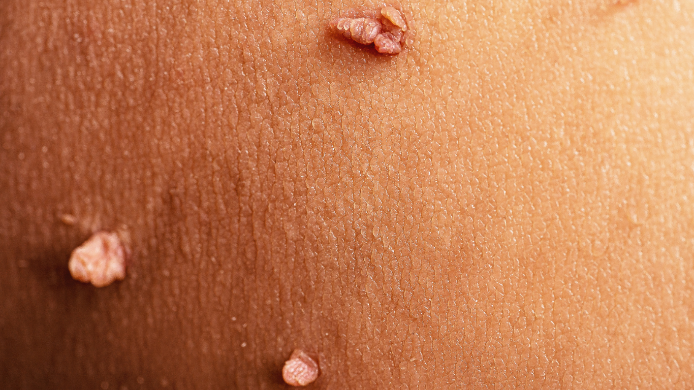 Warts removal per large size