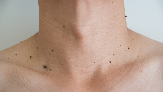 Warts removal: Neck