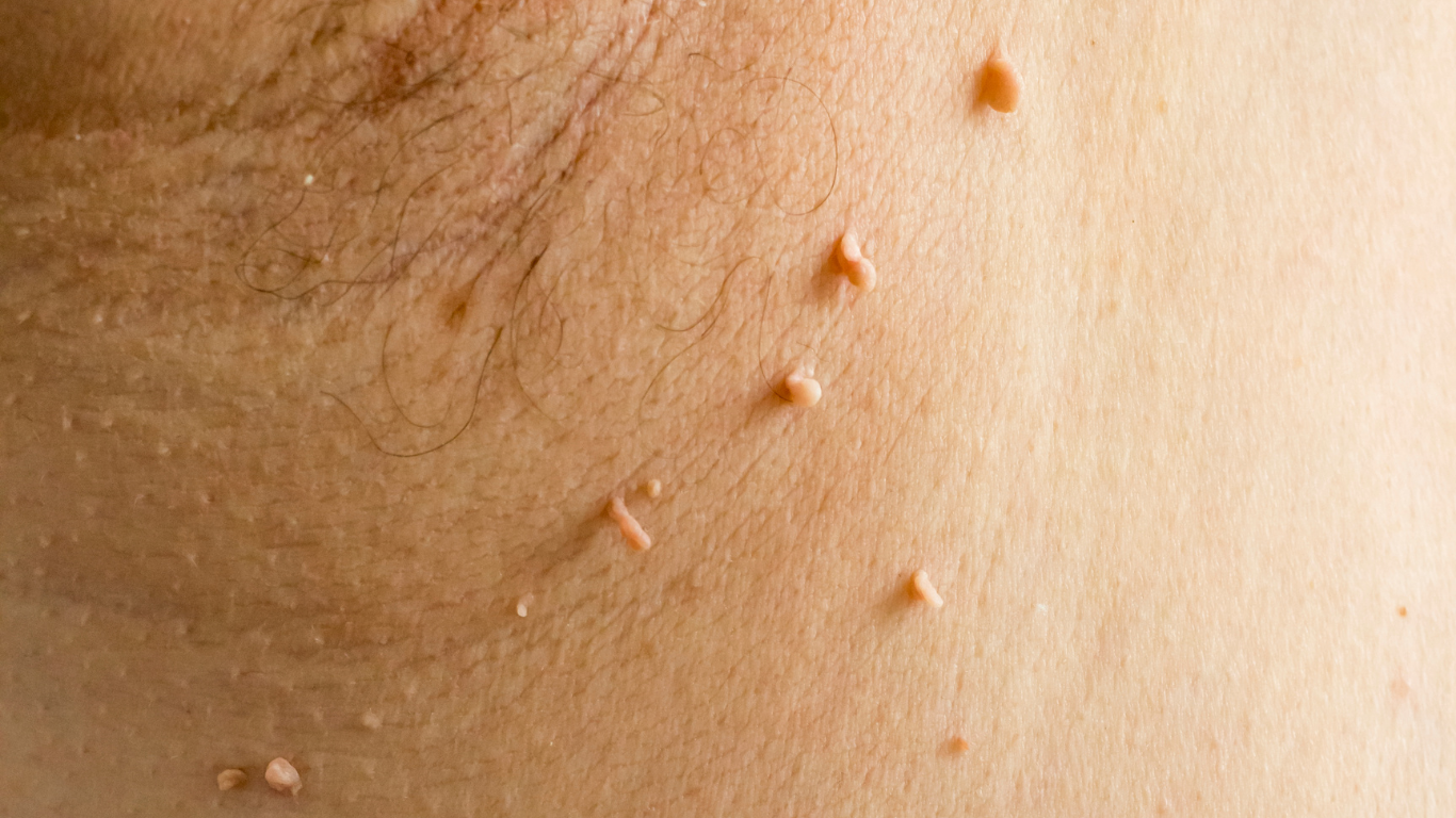 Warts removal: Underarm and Groin