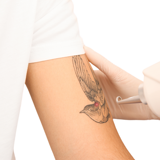 Laser Tattoo Removal [With 5 + 3 sessions option]
